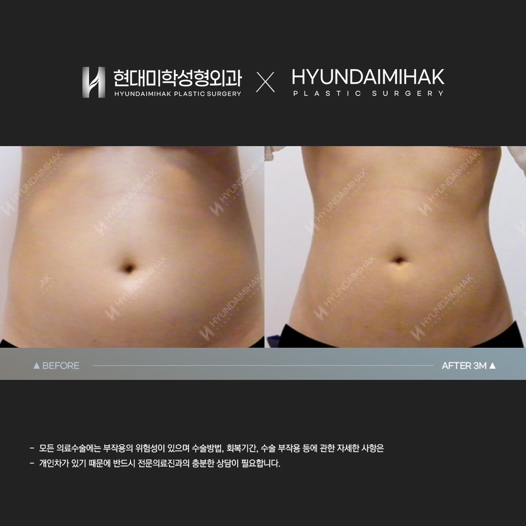 Abdominal Liposuction, 3 Months