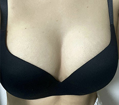 Wow… it's already been 5 months since my breast augmentation… ㅎㅎ