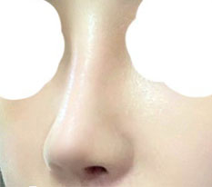 I succeeded with my nose surgery in one shot