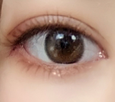 Eye revision, epicanthoplasty restoration, and lateral canthoplasty revision — all a success