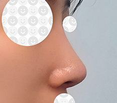 From a hump nose to a semi-straight nose