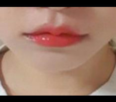 Cupid lip corner surgery~>3<♡