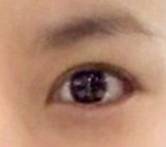 Even at one month after revision eyelid surgery, this feels like a success