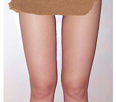 Thigh Liposuction Review