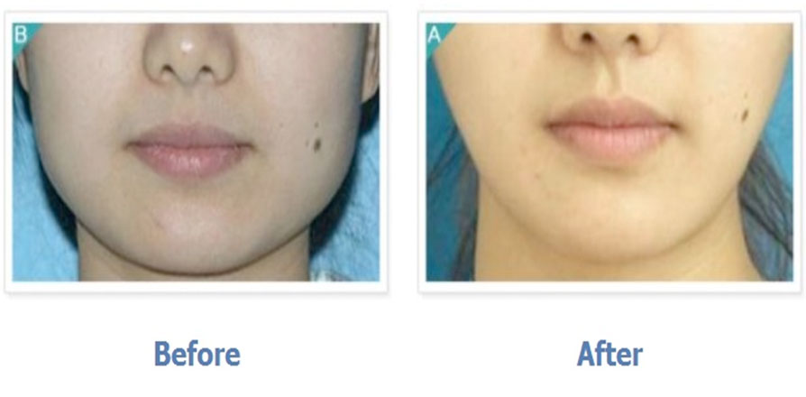 Square Jaw Surgery