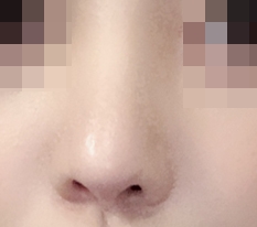 My pointy nose tip became soft and smooth!