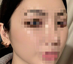 I had cheekbone surgery at cheekbone-specialist Hyundai Aesthetic Surgery ^^