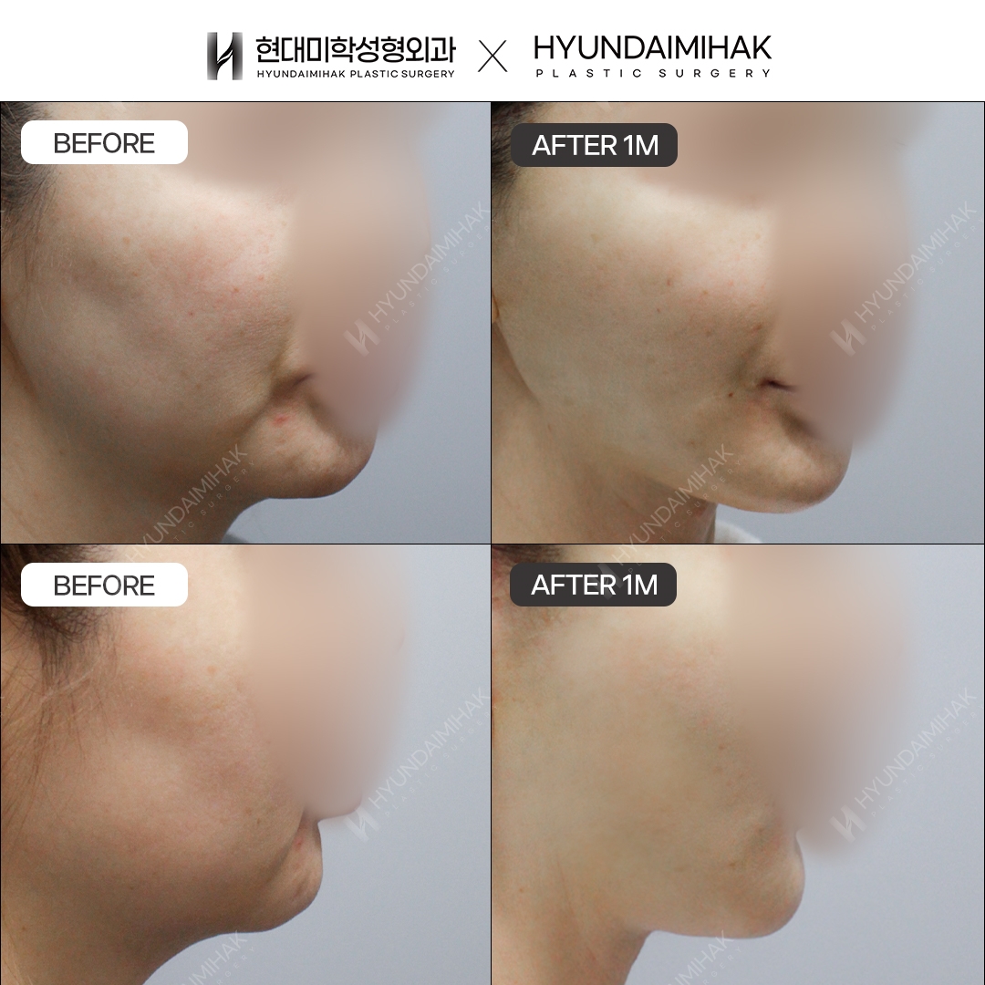 [Anti-Aging Surgery] Thread Lift, 1 Month