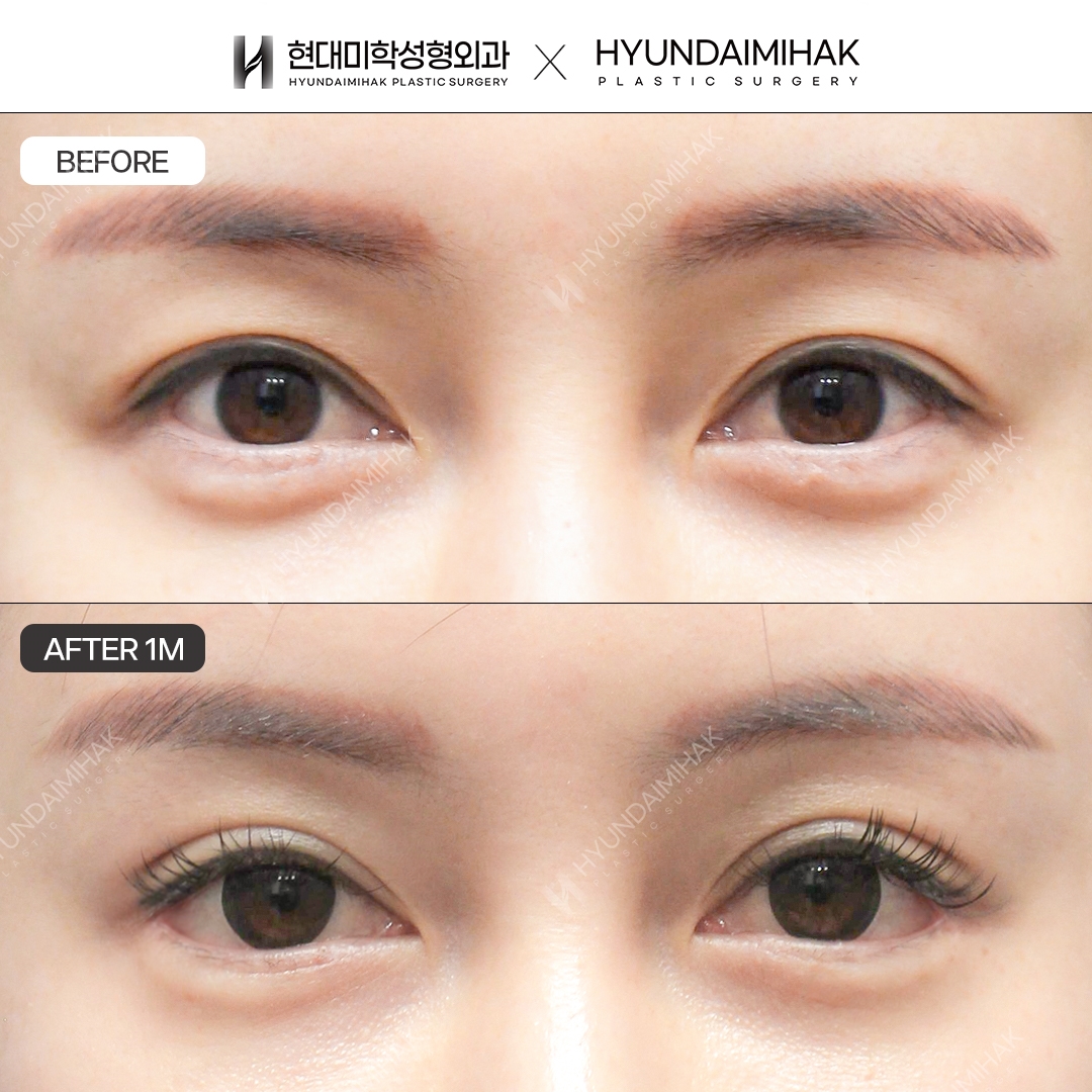 [Canthoplasty] Lateral Canthoplasty + Lower Canthoplasty