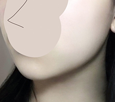 Chin Fat Cleanup Complete