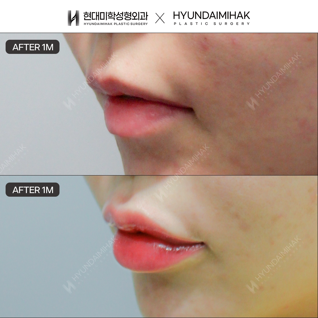 [Lip Surgery] Cupid's Bow Line and Asymmetry Correction, 1 Month