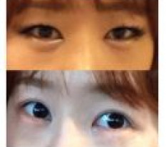 I only had the incision method, but my image changed to a softer one^^