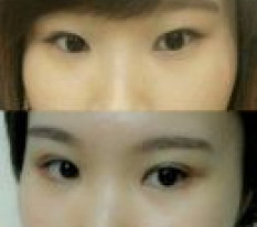 Why did I only get eye surgery now ㅋㅋ