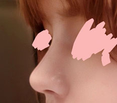 The surgery I agonized over for so long ended up being a huge success!