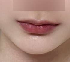 So Glad I Got the Lip Corner Lift haha