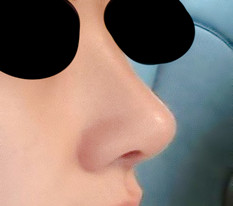 I recommend this clinic for nose surgery