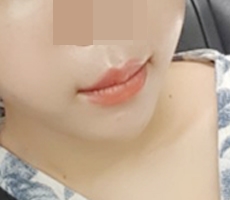 I got mouth-corner surgery because it was on promotion :D