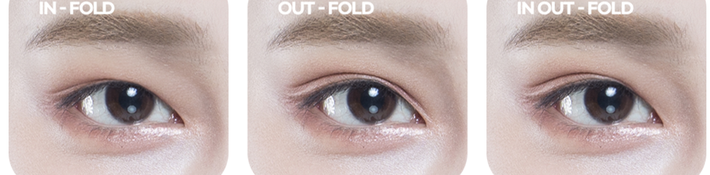 Shape of the front of the double eyelid (epicanthal fold error) case