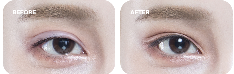 Sausage line (high crease) case