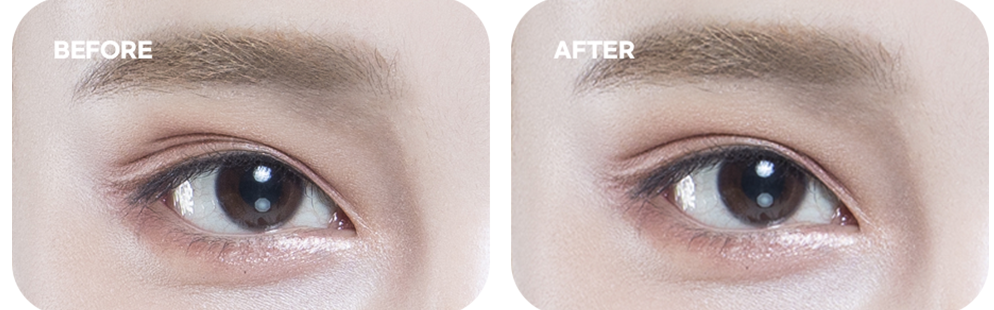 Triple eyelid (multiple creases) case