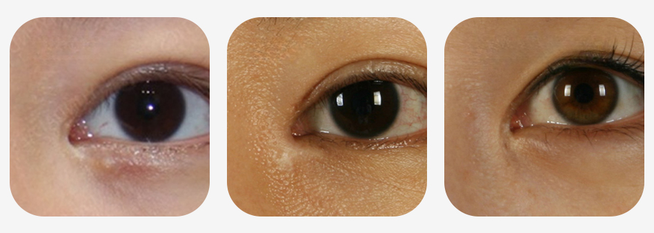 Scarring after epicanthoplasty case