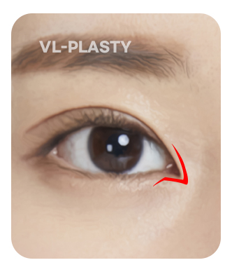Double-flap adjustment illustration