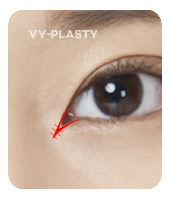 V-Y flap technique illustration