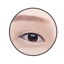 Lower canthoplasty step 1 — designing the suitable outer eye corner