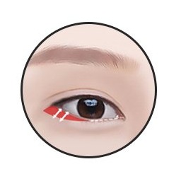 Lower canthoplasty step 2 — periosteal fixation after conjunctival incision