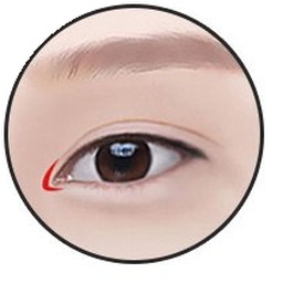 Epicanthoplasty step 2 — incising the Mongolian fold