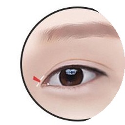 Epicanthoplasty step 3 — removing unnecessary skin