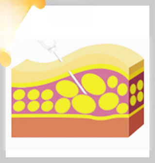 Before Fat Kill injection — cross-section of uneven fat cells