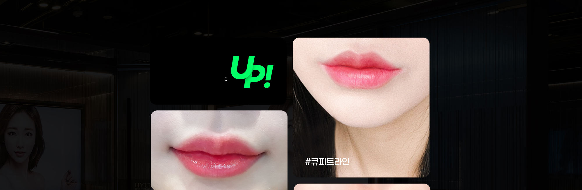 Before-and-after lip photos for Cupid Line lip surgery