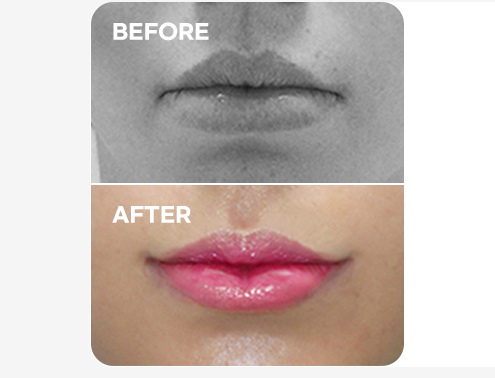 For Flat Lips Before & After
