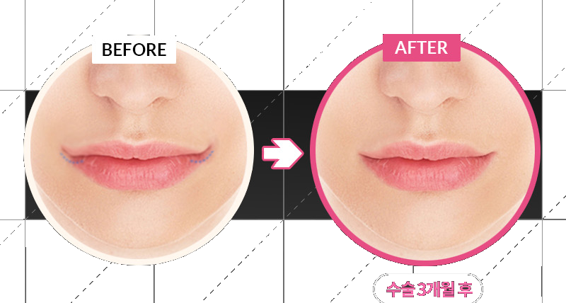 Before-and-after case of mouth corner revision surgery