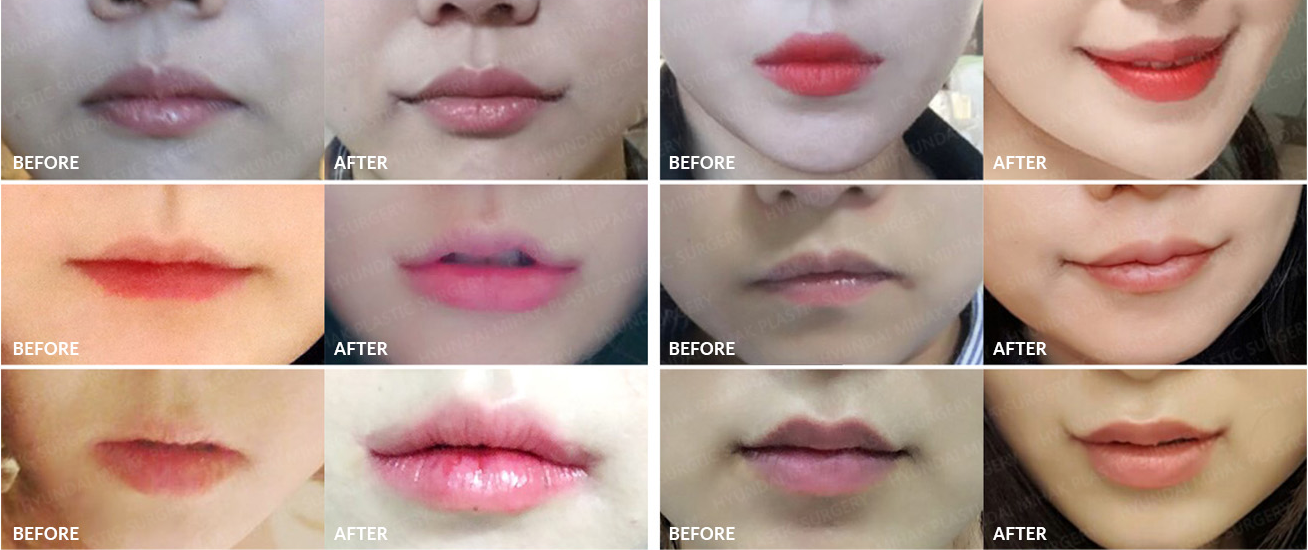 Before-and-after case of mouth corner revision surgery