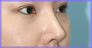 Arrowhead nose surgery after — side-view photo of the nose (AFTER)