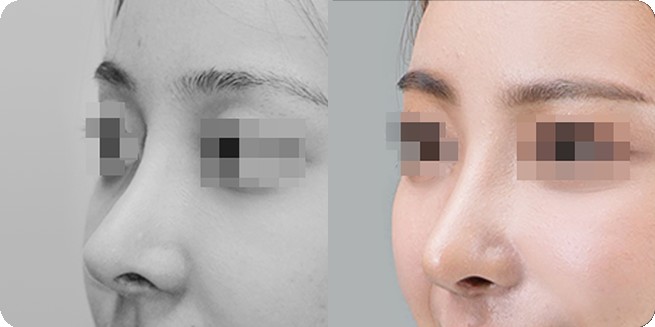 Side-view before-and-after comparison 1 of no-prosthesis rhinoplasty (BEFORE / AFTER 3MONTH)