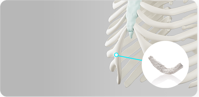 Illustration of donated rib cartilage
