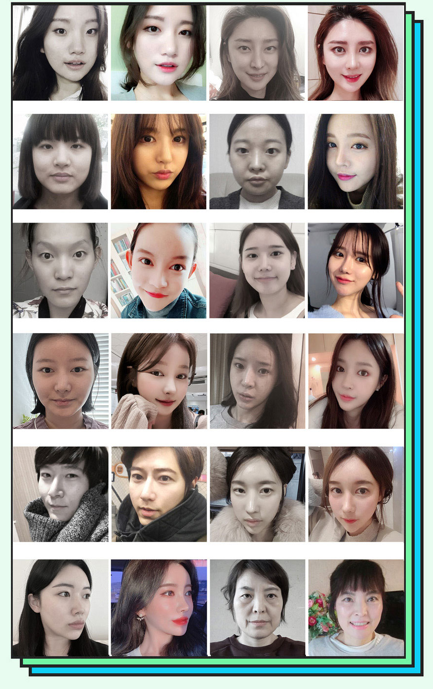 Before-and-after comparison photos of Hyundai Aesthetics crooked nose surgery
