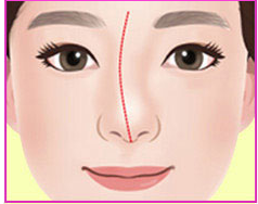 Illustration of a C-shaped crooked nose