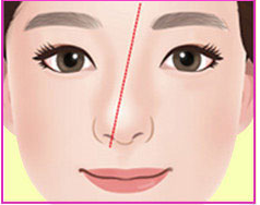 Illustration of a diagonally crooked nose