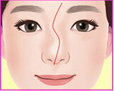 Illustration of an S-shaped crooked nose