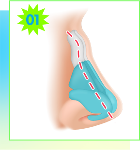 Surgical diagram for a deviated nasal bone