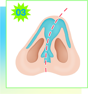 Surgical diagram for severe septal deviation
