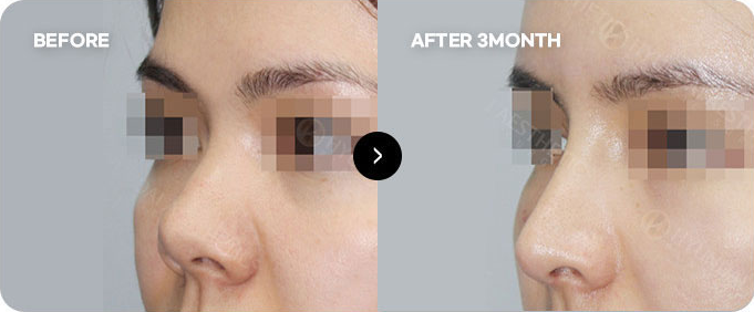 Before and after revision surgery for contracted nose 1