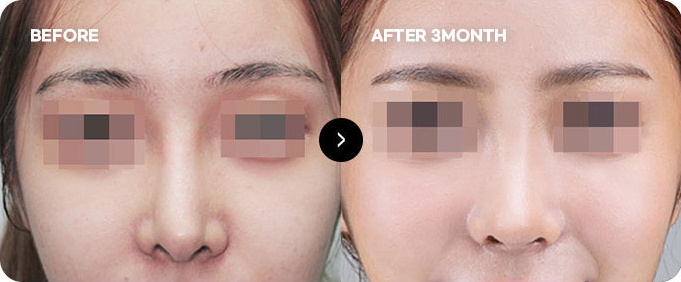 Before and after nasal tip line revision 2