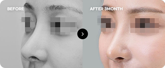 Before and after nasal tip line revision 3